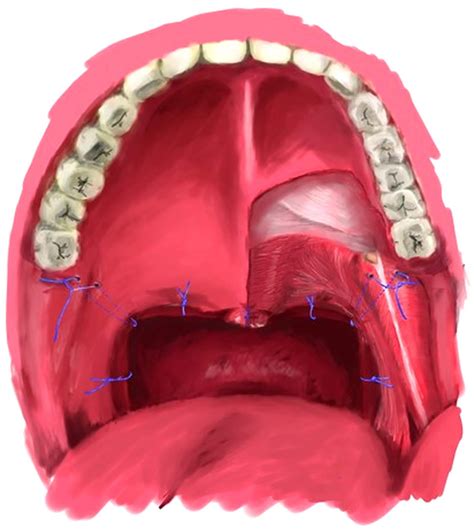 懸 壅 顎 咽 成形 術